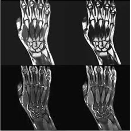 mri right hand with contrast